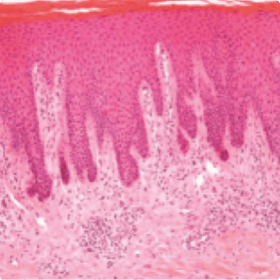(A) Psoriasis vulgaris characteristically shows acanthosis, parakeratosis, and dermal inflammatory infiltrates. 