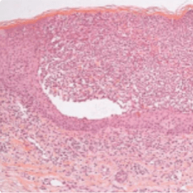 (B) In pustular psoriasis, acanthotic changes are accompanied by epidermal predominantly neutrophilic infiltrates, which cause pustule formation.