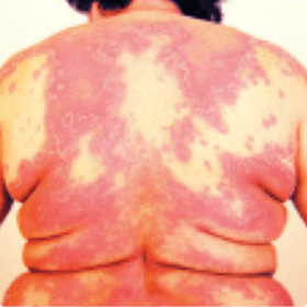 (C) Macroscopic features of GPP. 