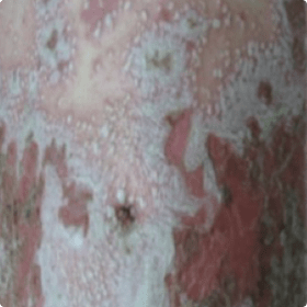 GPP skin lesions