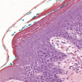 An image of munro and kogoj micropustules