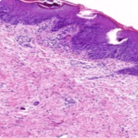 An image of vascular ectasia spongiform pustules