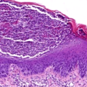 An image of prominent neutrophilic infiltrate