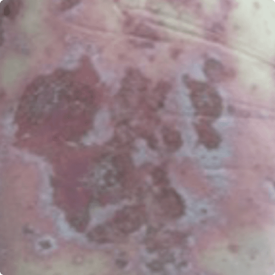 An image of skin with a GPP flare up